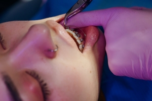 What to Expect When It's Time to Remove Your Braces What to Expect When It's Time to Remove Your Braces